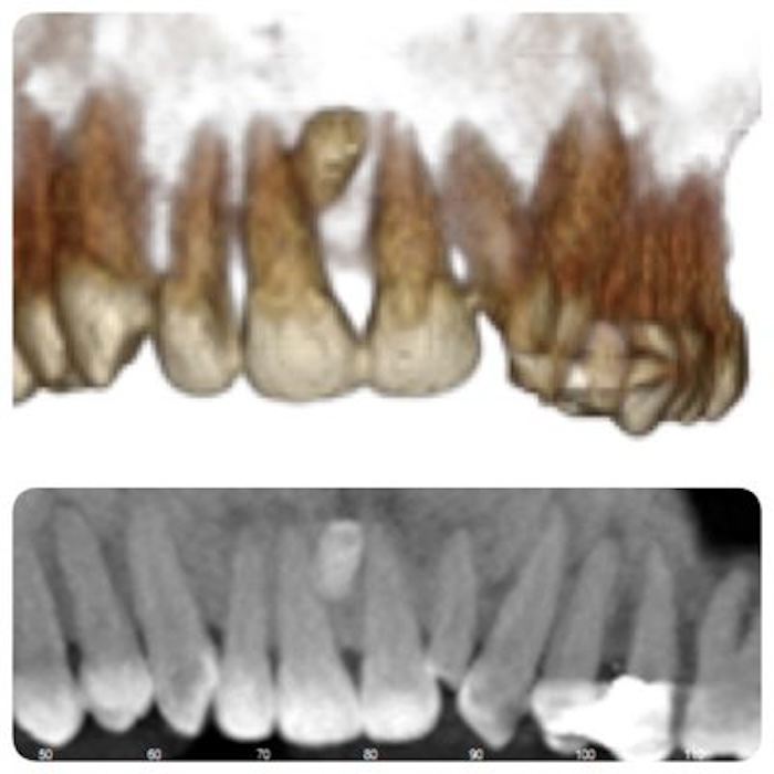 Dientes Supernumerarios