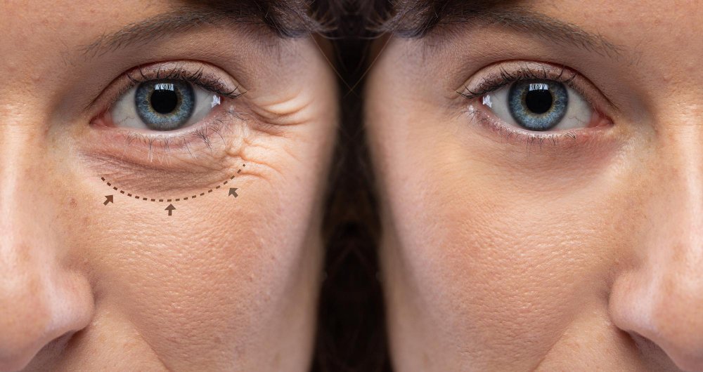 Blefaroplastia inferior