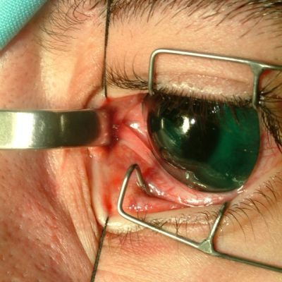 Fractura de pared de órbita