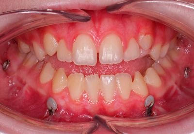 anclaje esquelético