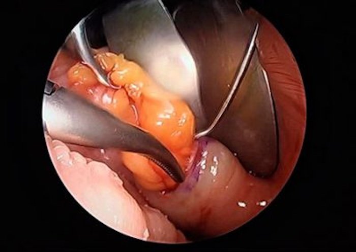 Antes y después de la bichectomía