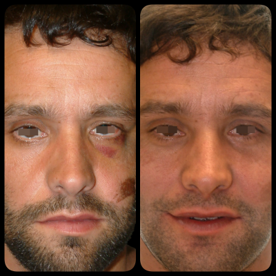 Fractura suelo órbita