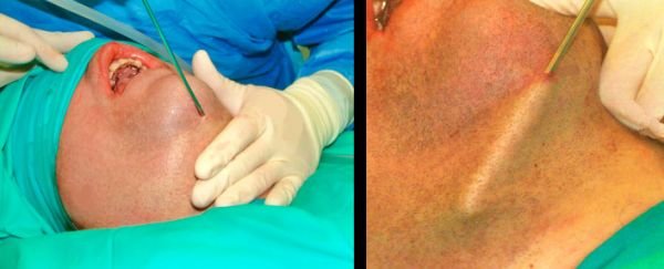 Liposucción de cuello