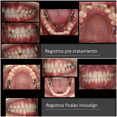 Ortodoncia invisible