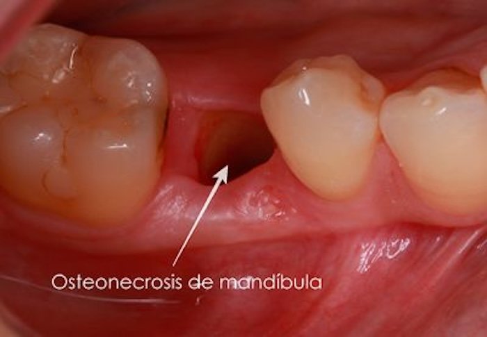 Necrosis mandibular o maxilar