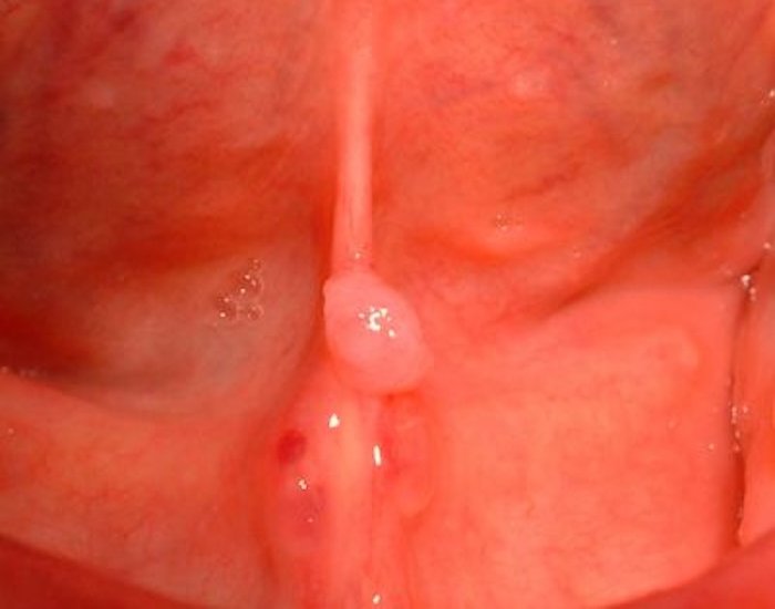 Biopsia de la mucosa oral