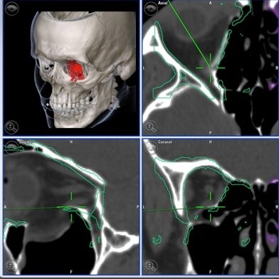 Fractura suelo órbita